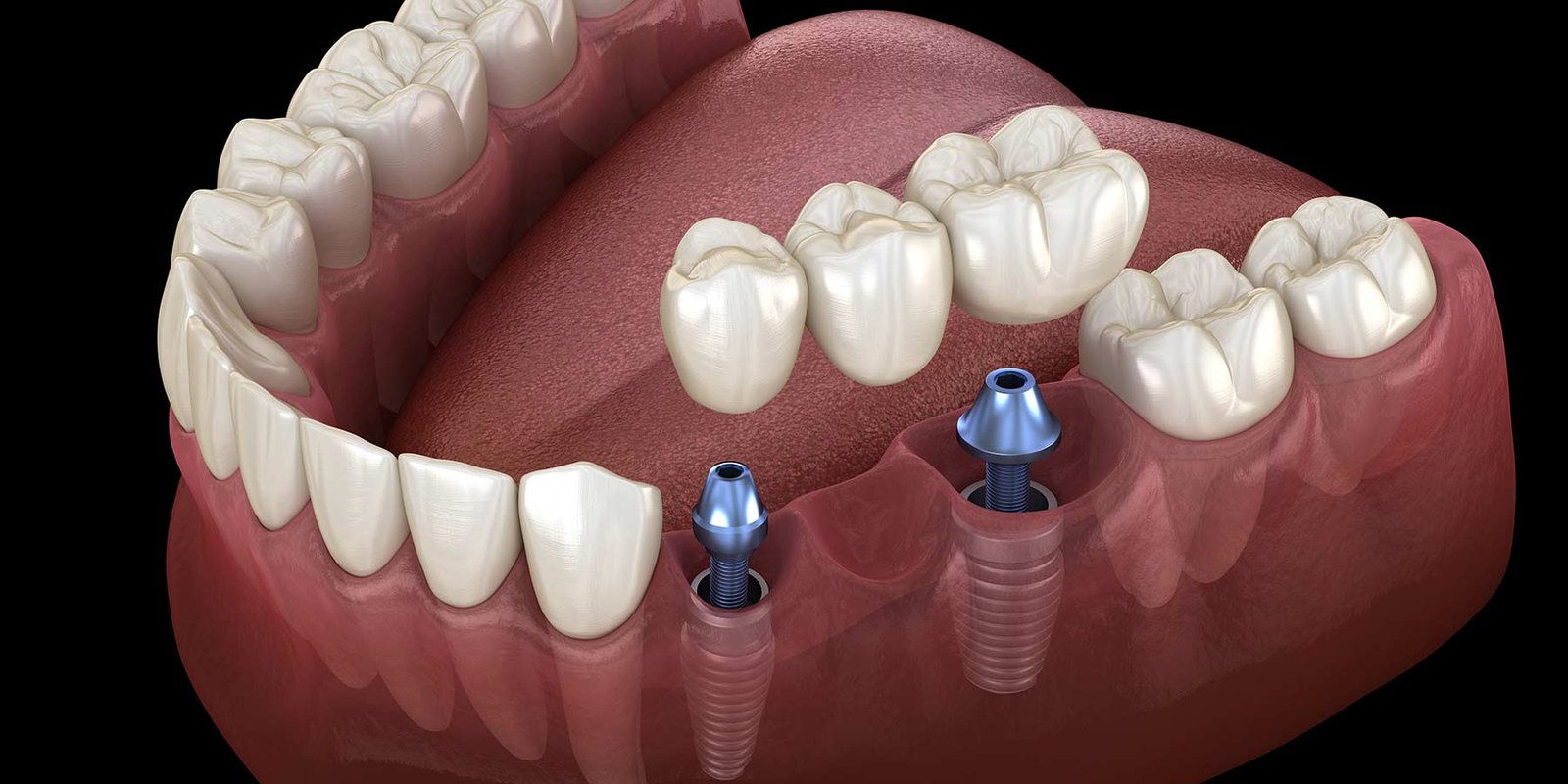 Dişlere implant 1