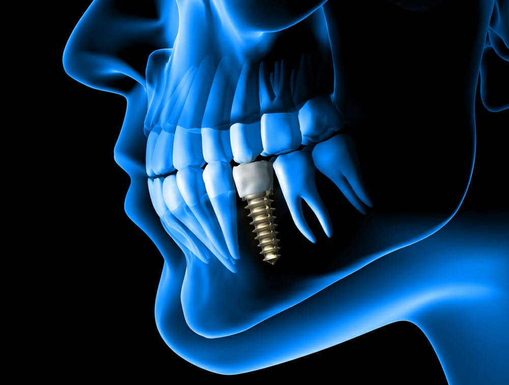 Dişlere implant
